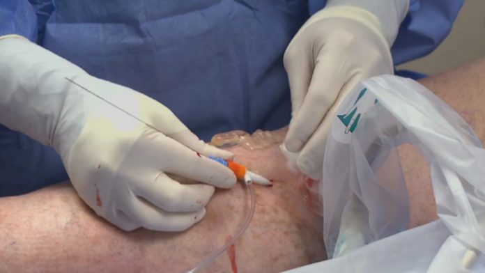 Advances in Cryoablation: How Extreme Cold is Changing Oncology